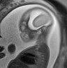Normal brain fetal MRI - 22 weeks (Radiopaedia 50623-56050 Sagittal T2 Haste 6).jpg
