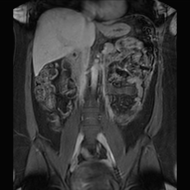 Normal liver MRI with Gadolinium (Radiopaedia 58913-66163 P 45).jpg