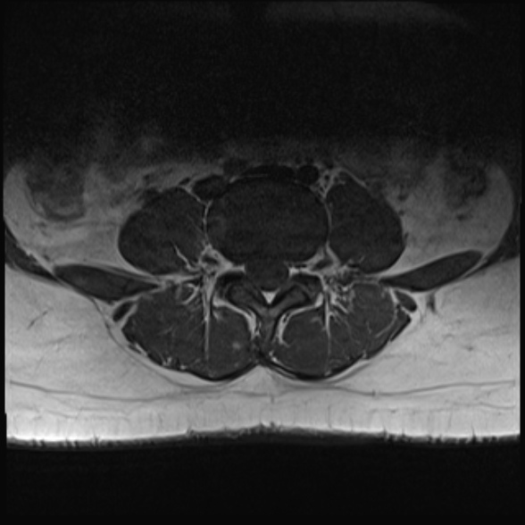 File:Normal lumbar spine MRI- 3 T (Radiopaedia 53280-59250 Axial 18).jpg