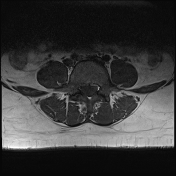 File:Normal lumbar spine MRI- 3 T (Radiopaedia 53280-59250 Axial 21).jpg