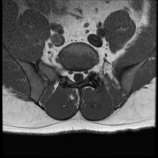 File:Normal lumbar spine MRI (Radiopaedia 35543-37039 Axial T1 7).png