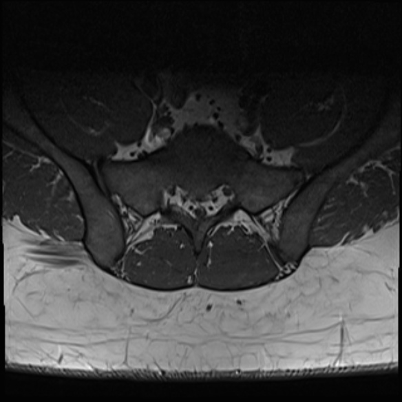 File:Normal lumbar spine MRI (Radiopaedia 47857-52609 Axial T1 32).jpg