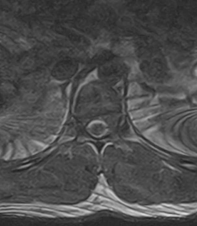 Normal lumbar spine MRI - low-field MRI scanner (Radiopaedia 40976-43699 Axial T2 1).jpg
