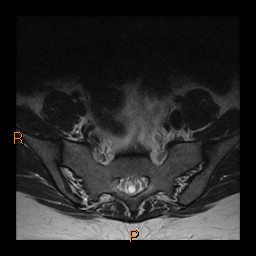File:Normal spine MRI (Radiopaedia 77323-89408 Axial T2 30).jpg