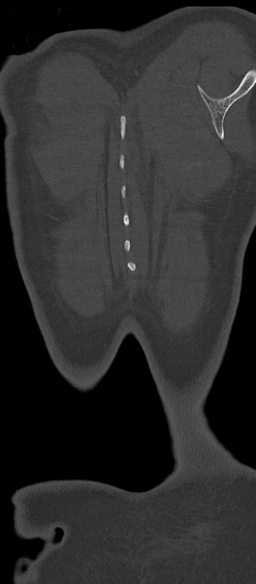 Normal thoracolumbar spine (Radiopaedia 43822-47309 Coronal bone window 91).png