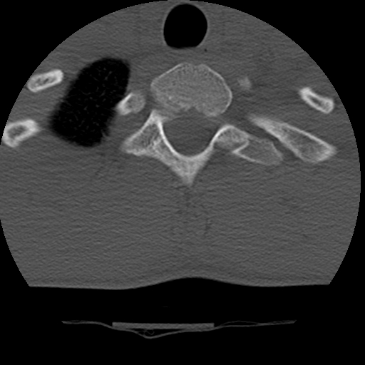 Normal trauma spine imaging (age 16) (Radiopaedia 45335-49358 Axial bone window 76).jpg