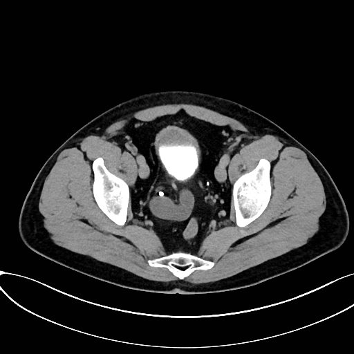 Obstructed upper pole ureter in a duplex kidney (Radiopaedia 54935-61221 Axial C+ delayed 96).jpg