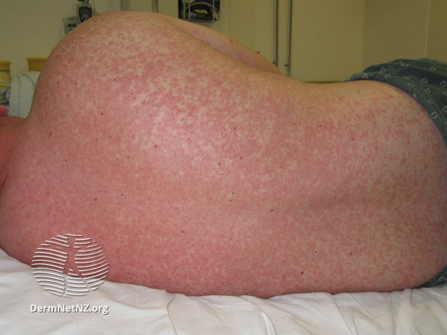 File:Rash Day 3 (DermNet NZ viral-measles08).jpg