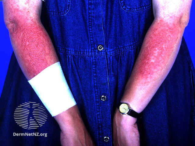File:Sunscreen reaction (DermNet NZ dermatitis-acdss).jpg