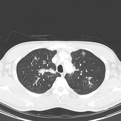 AIDS-related Kaposi sarcoma (Radiopaedia 85247-100811 Axial lung window 39).jpg