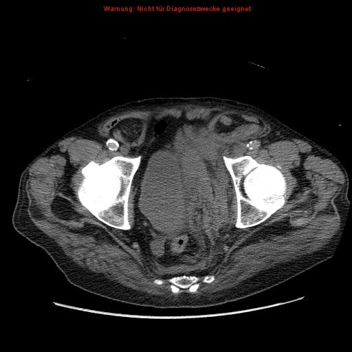 File:Abdominal aortic aneurysm- extremely large, ruptured (Radiopaedia 19882-19921 Axial C+ arterial phase 72).jpg