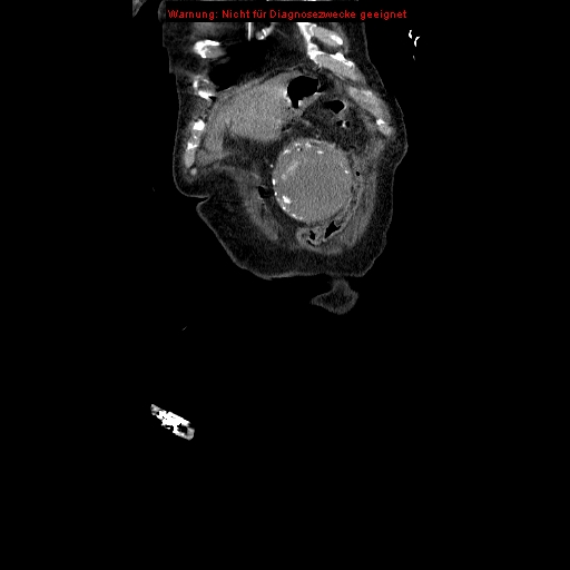 Abdominal aortic aneurysm- extremely large, ruptured (Radiopaedia 19882-19921 Coronal C+ arterial phase 11).jpg