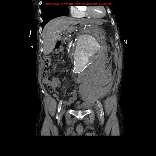 Abdominal aortic aneurysm- extremely large, ruptured (Radiopaedia 19882-19921 Coronal C+ arterial phase 42).jpg