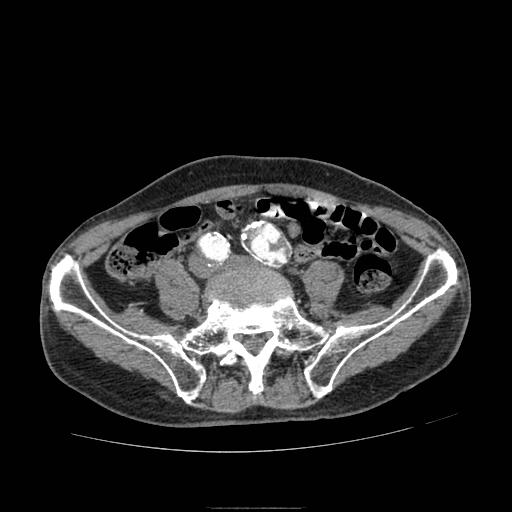 Abdominal aortic aneurysm (Radiopaedia 13341-13340 Axial C+ arterial phase 165).jpg