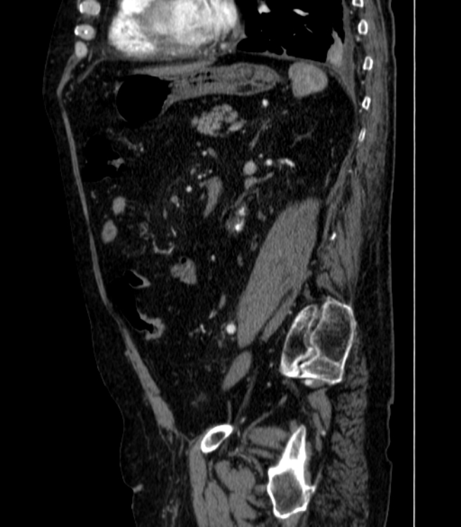 Abdominal aortic aneurysm (Radiopaedia 25855-26001 Sagittal C+ arterial phase 45).jpg