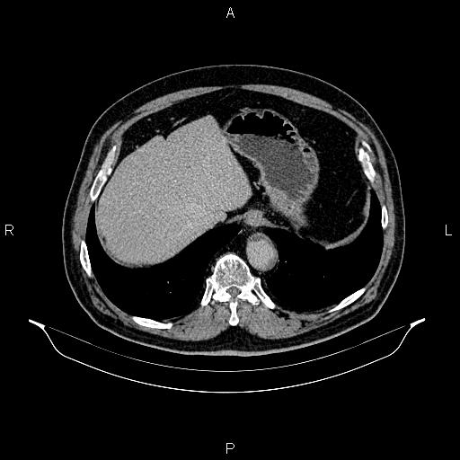 Abdominal aortic aneurysm (Radiopaedia 83094-97462 Axial renal excretory phase 20).jpg