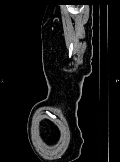 Abdominal aortic aneurysm (Radiopaedia 83094-97462 Sagittal renal cortical phase 6).jpg