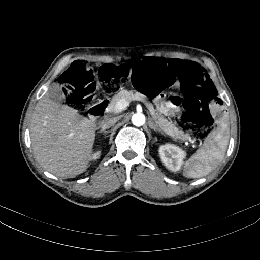 File:Abdominal aortic aneurysm (Radiopaedia 83581-98689 Axial C+ arterial phase 41).jpg
