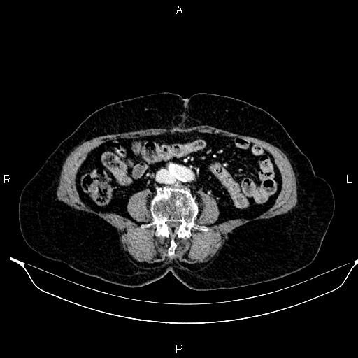 File:Abdominal aortic aneurysm (Radiopaedia 85063-100606 Axial C+ portal venous phase 46).jpg