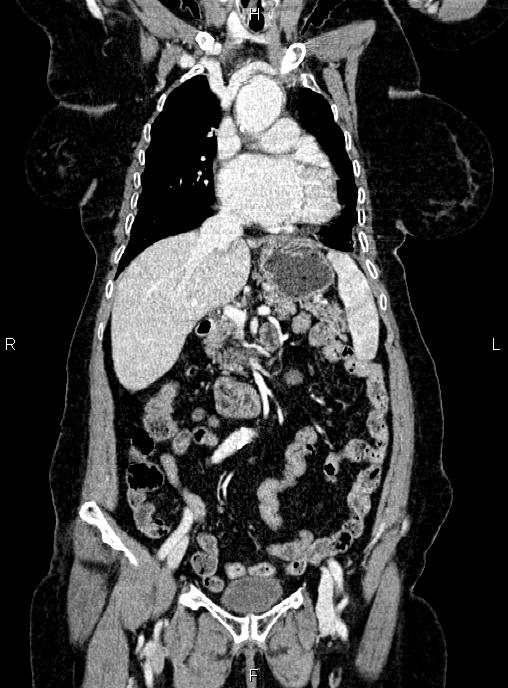 Abdominal aortic aneurysm (Radiopaedia 85063-100606 Coronal C+ arterial phase 20).jpg