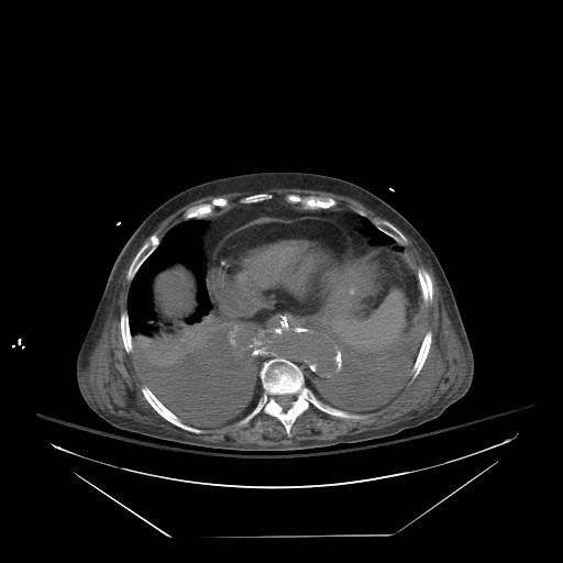 Abdominal aortic aneurysm - impending rupture (Radiopaedia 19233-19247 Axial non-contrast 27).jpg