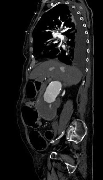 Abdominal aortic aneurysm with thrombus fissuration (Radiopaedia 73192-83919 Sagittal C+ arterial phase 93).jpg