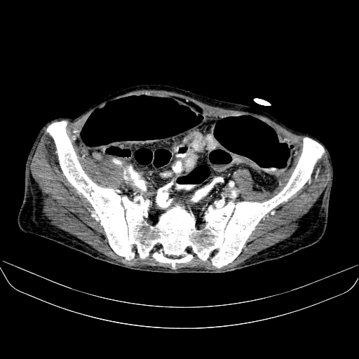 File:Abdominal collection due to previous cecal perforation (Radiopaedia 80831-94320 Axial C+ portal venous phase 161).jpg