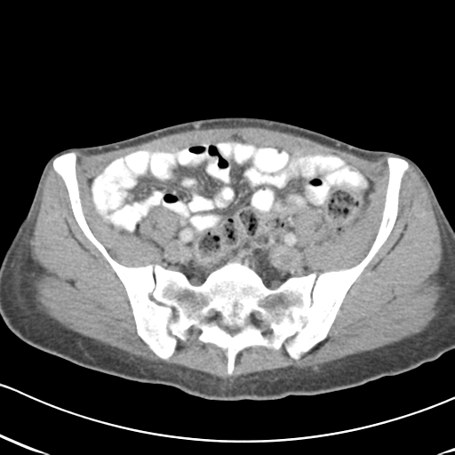 Abdominal desmoid tumor (Radiopaedia 41007-43740 Axial C+ portal venous phase 53).png