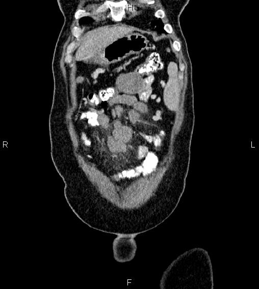 Abdominal lymphoma with sandwich sign (Radiopaedia 84378-99704 Coronal C+ portal venous phase 3).jpg