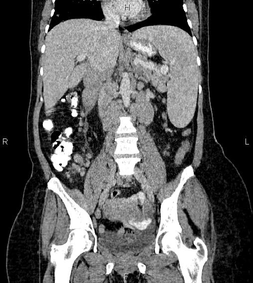 Abdominal lymphoma with sandwich sign (Radiopaedia 84378-99704 Coronal C+ portal venous phase 34).jpg