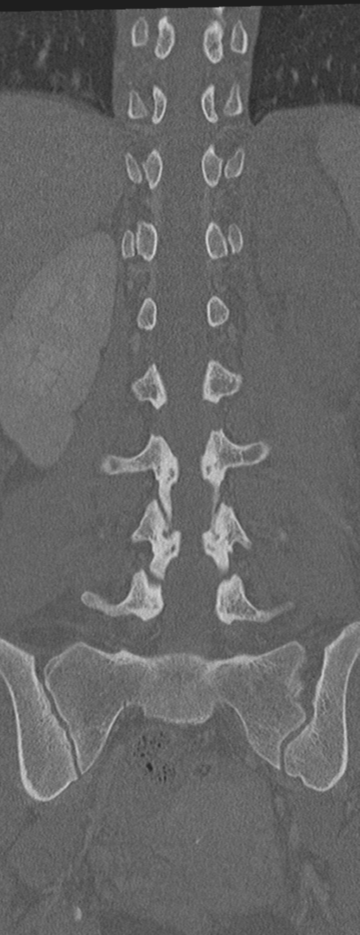 Abdominal multi-trauma - devascularised kidney and liver, spleen and pancreatic lacerations (Radiopaedia 34984-36486 Coronal bone window 43).png