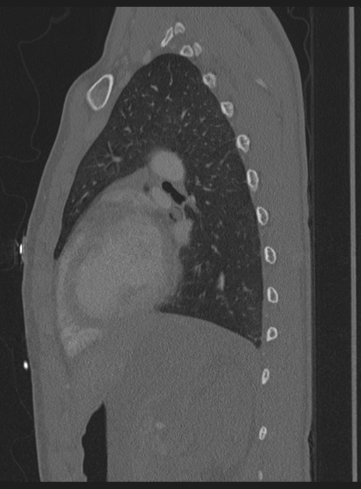 Abdominal multi-trauma - devascularised kidney and liver, spleen and pancreatic lacerations (Radiopaedia 34984-36486 Sagittal bone window 11).png