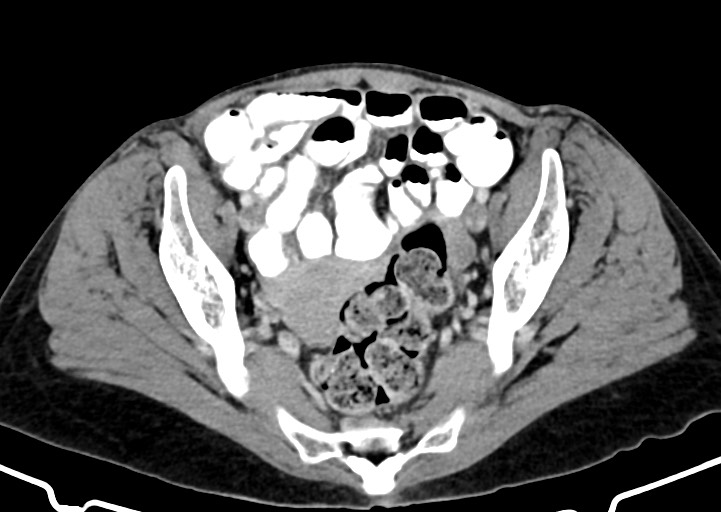 Abdominal wall and retroperitoneal tuberculosis (Radiopaedia 88137-104729 Axial C+ portal venous phase 158).jpg