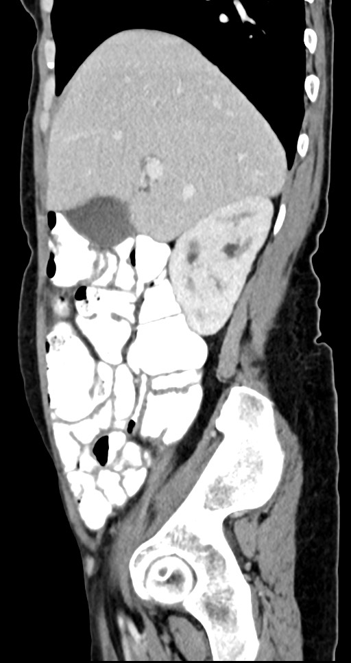 Abdominal wall and retroperitoneal tuberculosis (Radiopaedia 88137-104729 Sagittal C+ portal venous phase 107).jpg