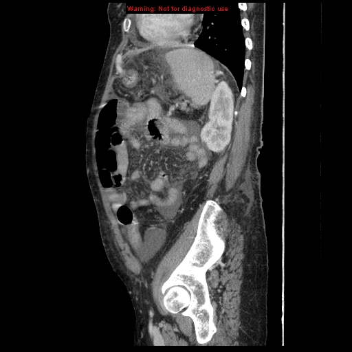Abdominal wall hematoma (Radiopaedia 9427-10112 Sagittal C+ portal venous phase 29).jpg