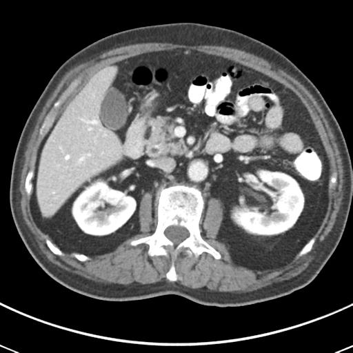 Abdominal wall metastasis from colorectal carcinoma (Radiopaedia 31016-31717 Axial C+ portal venous phase 29).jpg
