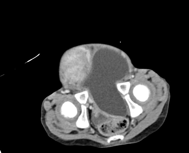 Abdominopelvic rhabdomyosarcoma (Radiopaedia 78356-90984 Axial C+ portal venous phase 146).jpg
