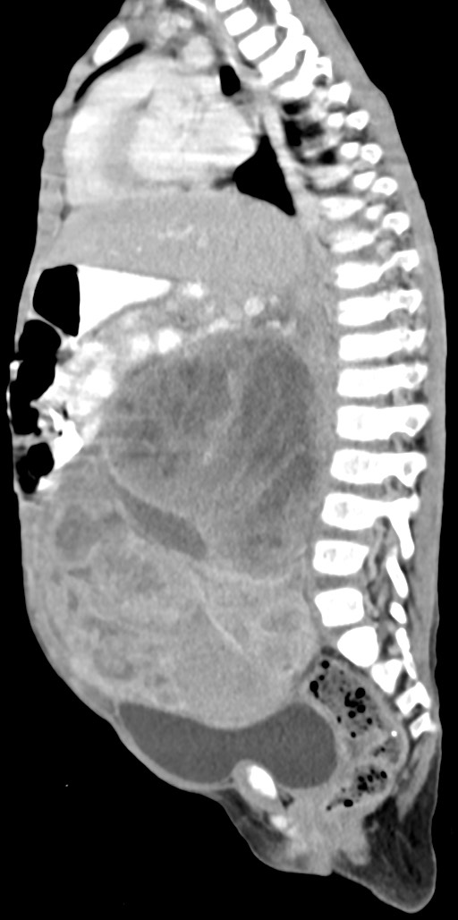 Abdominopelvic rhabdomyosarcoma (Radiopaedia 78356-90984 Sagittal C+ portal venous phase 48).jpg