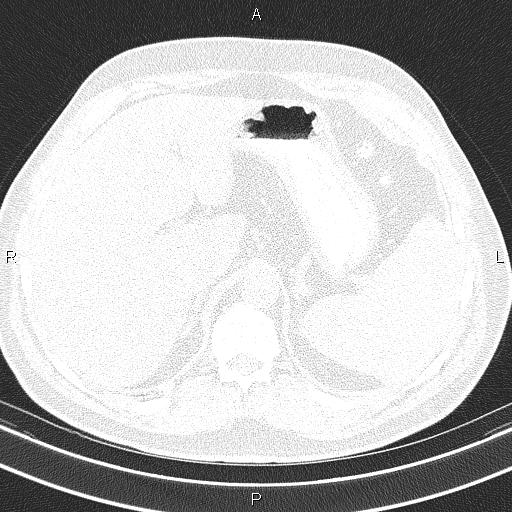 Aberrant right subclavian artery (Radiopaedia 87093-103354 Axial lung window 113).jpg