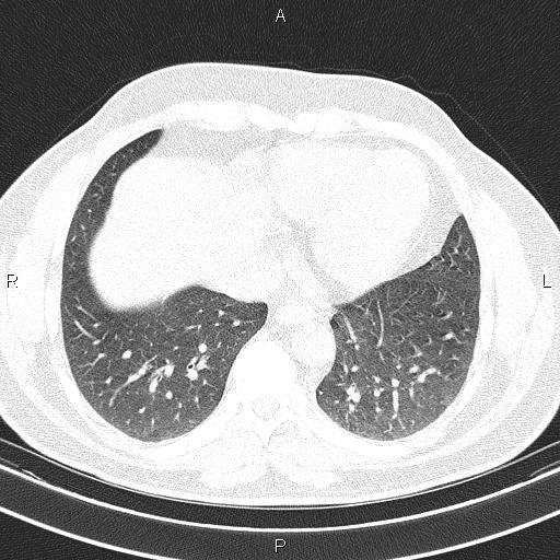 Aberrant right subclavian artery (Radiopaedia 87093-103354 Axial lung window 81).jpg