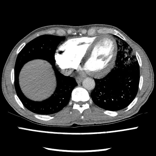File:Accessory left horizontal fissure with lingular pneumonia (Radiopaedia 53763-59843 Axial C+ CTPA 69).jpg