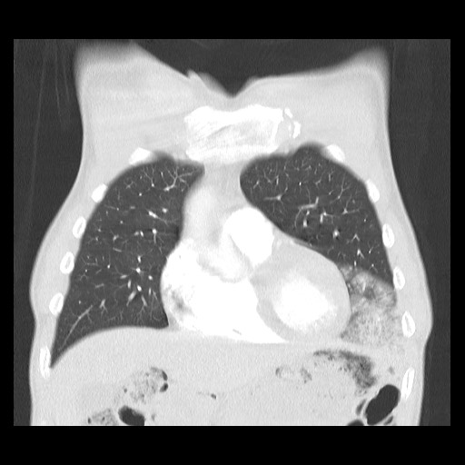 Accessory left horizontal fissure with lingular pneumonia (Radiopaedia 53763-59843 Coronal lung window 13).jpg