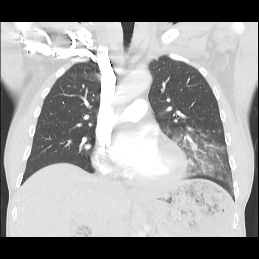 Accessory left horizontal fissure with lingular pneumonia (Radiopaedia 53763-59843 Coronal lung window 21).jpg