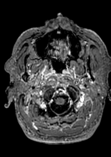 Accessory middle cerebral artery (Radiopaedia 73114-83828 Axial T1 C+ 193).jpg