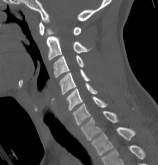 File:Accessory ossicle of the anterior arch of C1 vertebra (Radiopaedia 58149-65211 Sagittal bone window 11).jpg