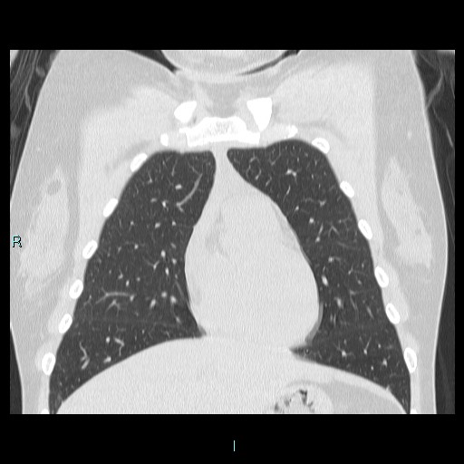 Accidental foreign body aspiration (seamstress needle) (Radiopaedia 77740-89983 Coronal lung window 46).jpg