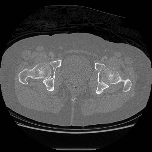 File:Acetabular fracture (Radiopaedia 13193-13212 Axial bone window 36).jpg