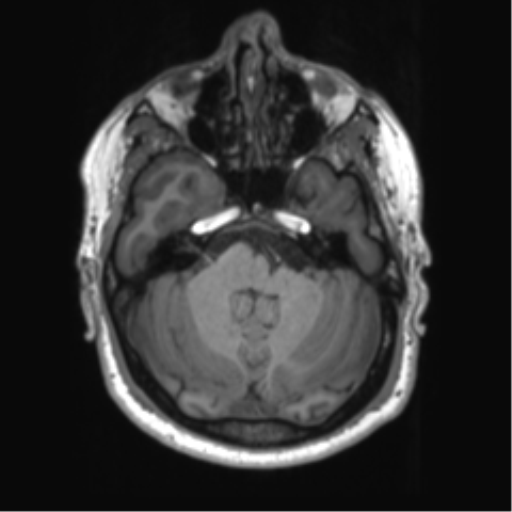 File:Achondroplasia (Radiopaedia 65109-74105 Axial T1 42).png