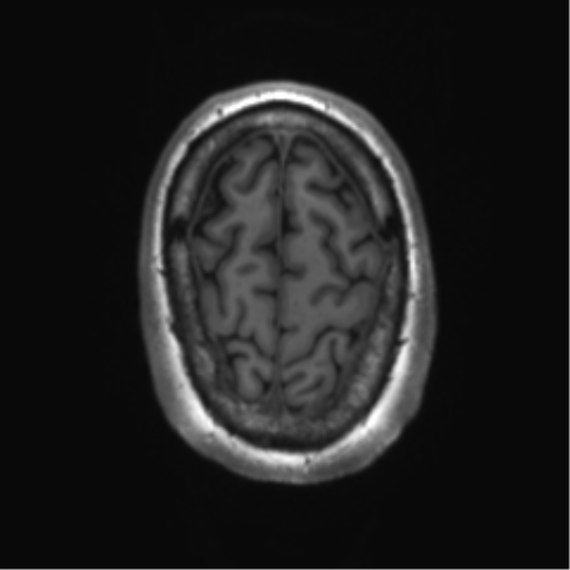 File:Achondroplasia (Radiopaedia 65109-74105 Axial T1 7).png