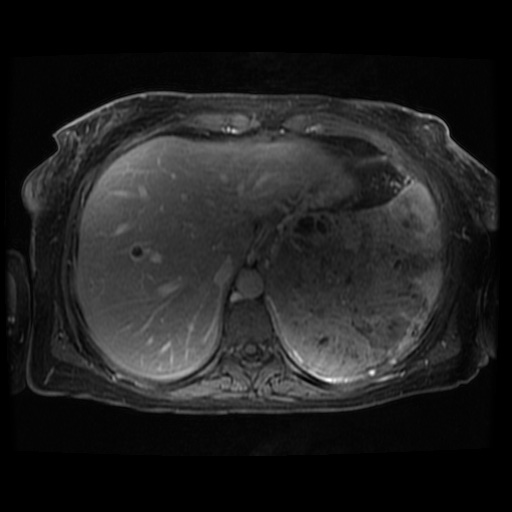 Acinar cell carcinoma of the pancreas (Radiopaedia 75442-86668 Axial T1 C+ fat sat 112).jpg
